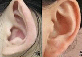 呂梁杯狀耳整形價格