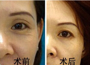 昭通眼部除皺價格