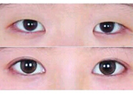 南充雙眼皮價(jià)格