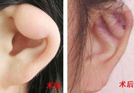 呂梁耳垂畸形修復價格