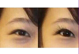 南充去黑眼圈價格