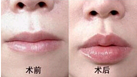 黃岡薄唇增厚價格