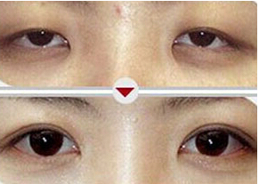 南通上瞼松弛矯正價格