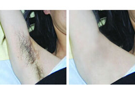 南充脫腋毛價(jià)格