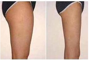 南充大腿吸脂價格
