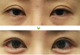 淮安上瞼松弛矯正價格