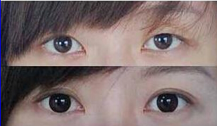 淮安下瞼外翻矯正價格
