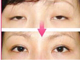韶關下瞼外翻矯正價格
