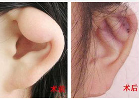 南充耳垂畸形修復(fù)價(jià)格