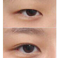 淮安眼瞼缺損整復術價格