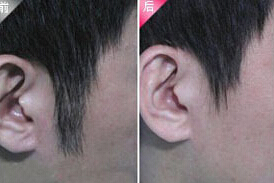 南通發際線脫毛價格