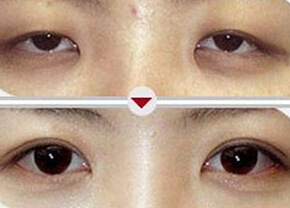 溫州上瞼松弛矯正價格