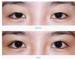 溫州水泡眼矯正價格