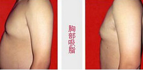 南通胸部吸脂價格