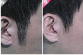 溫州發際線脫毛價格