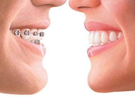 描述:牙齿矫正是通过正畸或外科手术等方法治疗错颌畸形
