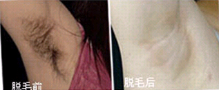 珠海脫腋毛價(jià)格