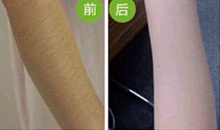 珠海手臂脫毛價(jià)格