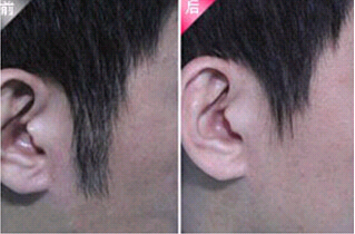 珠海發際線脫毛價格