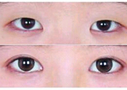 双眼皮案例 塑造闪电闪电的眼眸
