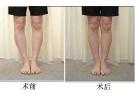溫州O型腿矯正價格