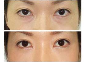 寧波去黑眼圈價(jià)格