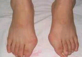珠海拇外翻矯正價格