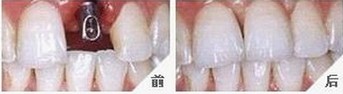 寧波牙槽骨手術價格