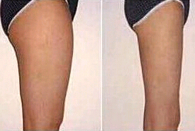 佛山大腿吸脂價格