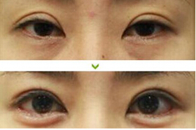 棗莊上瞼松弛矯正價格