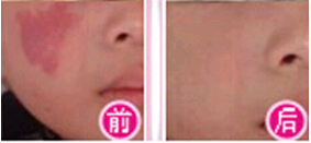 佛山鮮紅斑痣價格
