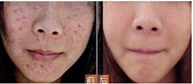 佛山微針美塑手術