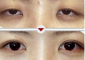 棗莊瞼眶溝填充價格