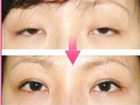 棗莊下瞼外翻矯正價格