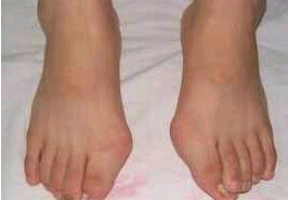 佛山拇外翻（大腳骨）矯正價格
