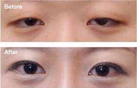 中山上瞼松弛矯正價格