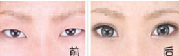 棗莊眼部綜合術價格