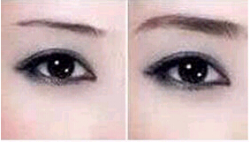 中山提眉術價格