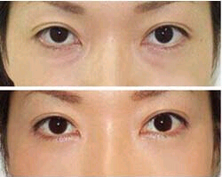 中山去黑眼圈價格