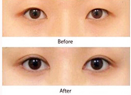 棗莊眼瞼病損切除術案例