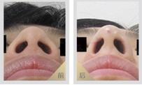 德宏鼻尖鼻翼縮小價格