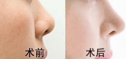 福州比华利膨体隆鼻效果好不好呢？