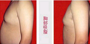 中山胸部吸脂價格