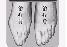 中山寬腳變窄術(shù)價(jià)格