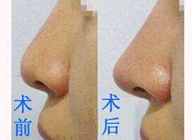 東莞鼻尖整形價(jià)格