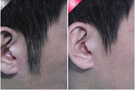 東莞發際線脫毛價格