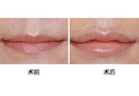 棗莊薄唇增厚價格