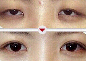 汕頭上瞼松弛矯正價(jià)格