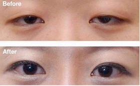 汕頭眼瞼下垂矯正價格