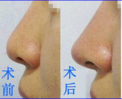 汕頭鼻尖整形價格